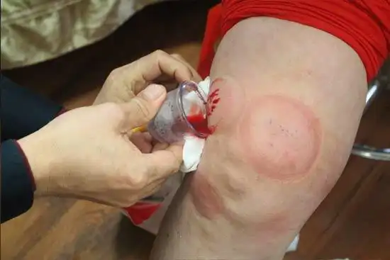 滑囊炎有哪些治疗方法