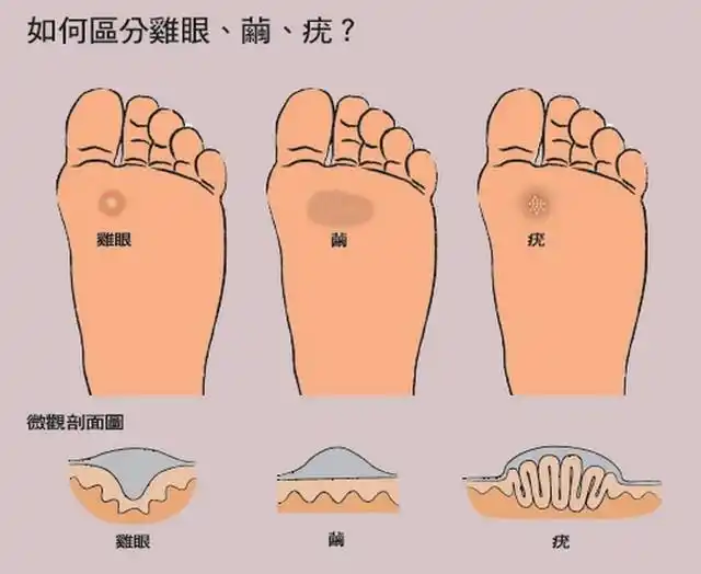 怎么样判断是不是鸡眼?