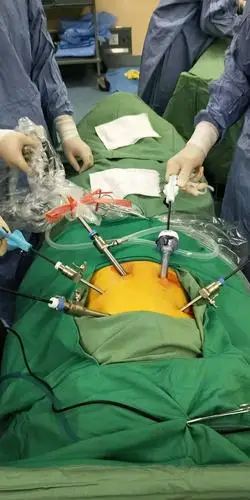 我院普通外科成功完成首例完全腹腔镜下胰头十二指肠切除术!