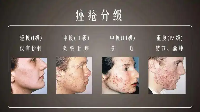 写美篇一:痘痘属于痤疮!