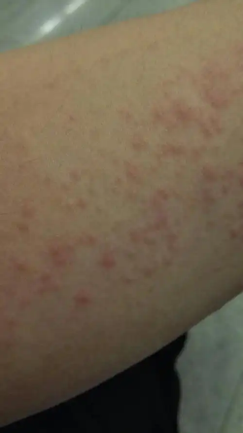 胳膊上起了一片小红点,请问这是什么毛病.突然起的