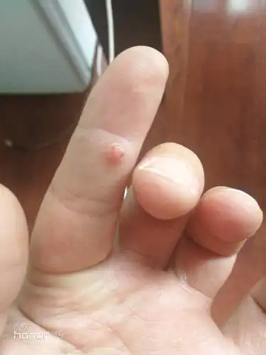 手指上起了个像鸡眼一样的,是什么东西啊,剪了还会长