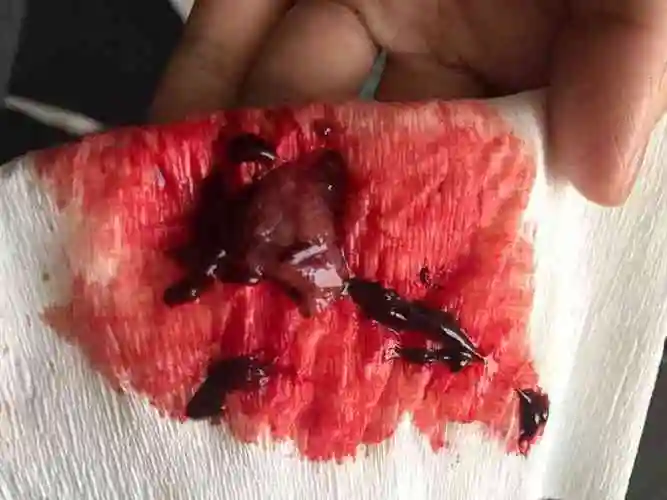 谁能分享一下掉下来的完整孕囊图片吗