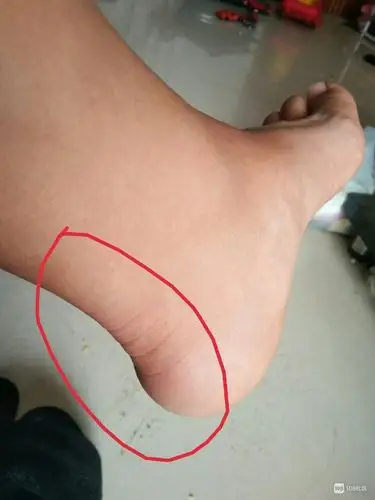 脚后跟的筋痛,也没有扭