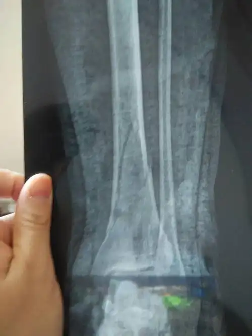 小腿左胫腓骨中下段粉碎骨折,保守治疗.