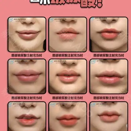 玻尿酸注射丰唇后注意事项