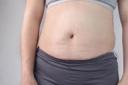 大腿有妊娠纹女性腹部皮肤有妊娠纹和l照片