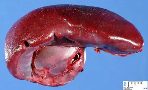 我40年前脾脏切除 脾脏切除后能买保险吗