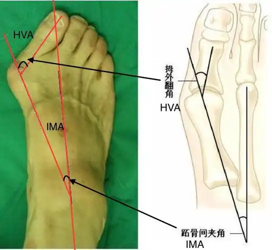 拇外翻_介绍_发病原因_症状表现_治疗方式_日常注意事项 - 好大夫