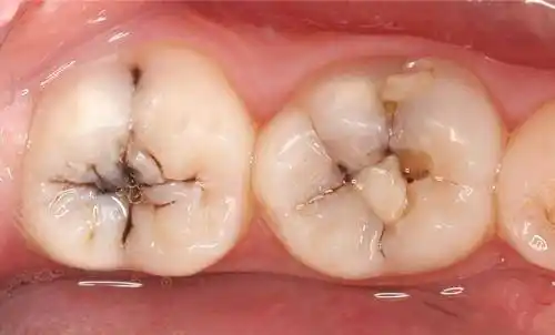 专门祸害磨牙的龋病窝沟龋