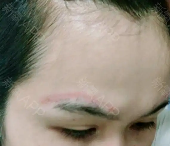 之前做了整形,眉上提眉,有两条很长的疤痕,半年了,_圈子-新氧美容整形