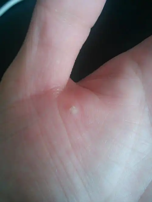 手掌上长了一个硬邦邦的东西,都两个多月了还没消失,求组这是什么东西