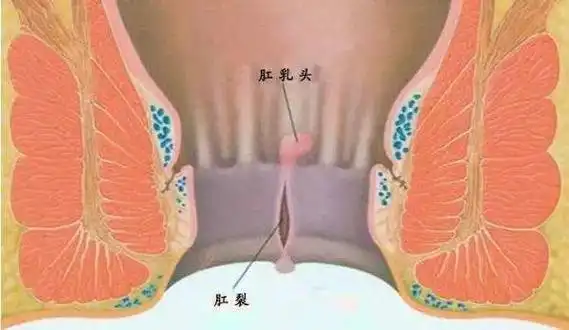 一种容易被人忽视的肛门炎症:肛窦炎?