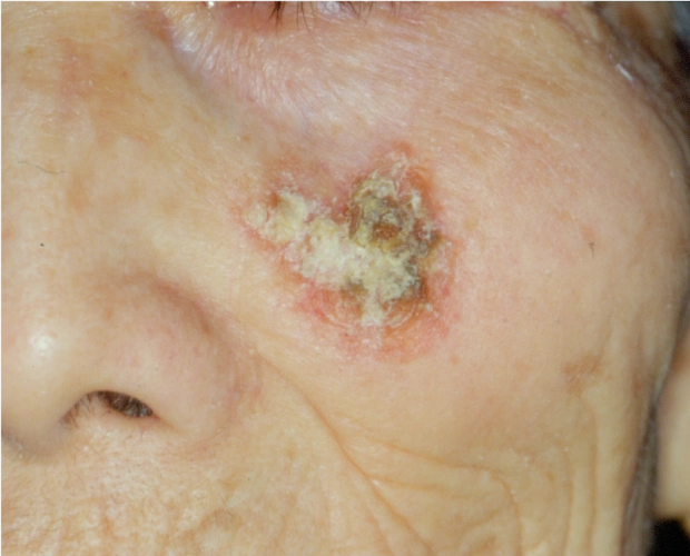 什么是鳞状细胞癌?是如何引起的?如何预防与治疗?