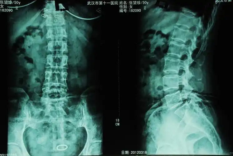尾椎l5向后滑脱1/4 1度