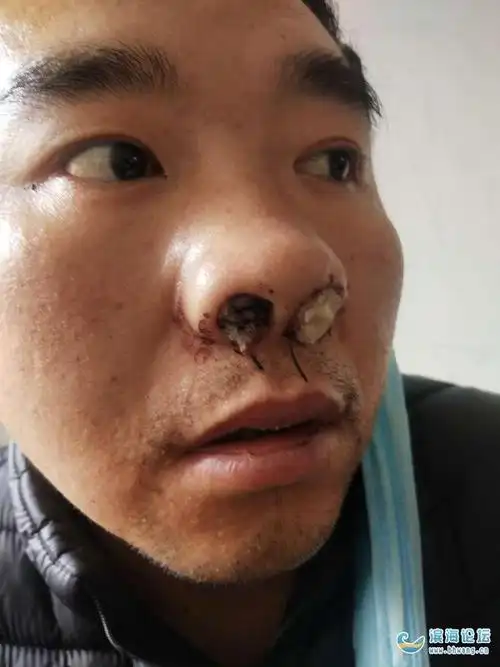 在滨海康达医院做鼻息肉手术鼻孔大出血返院住一星期出院是否是医疗