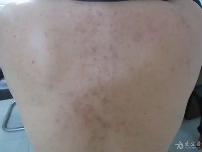男士背部的瘙痒—— 脂溢性皮炎