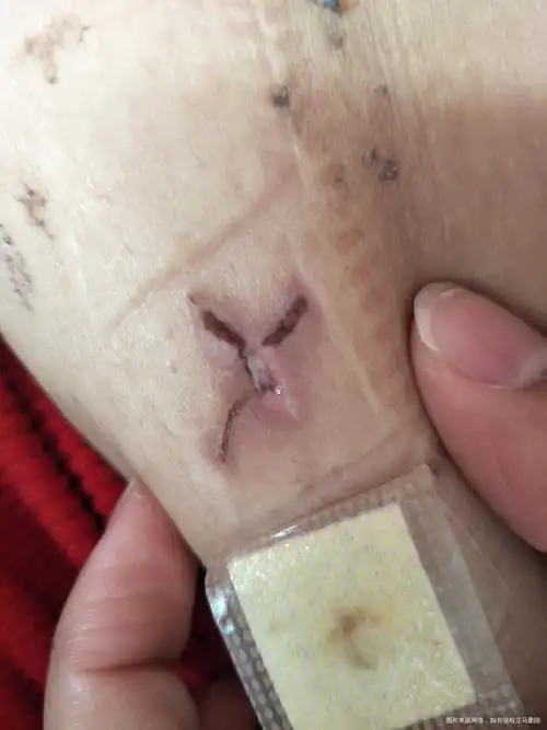 11月30号做的宫腹腔镜现在伤口上有白色的