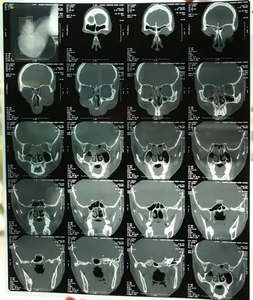 谁来帮忙看下我这张鼻部ct片