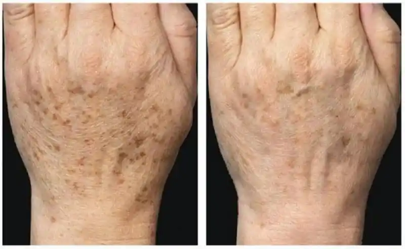 手背上长了老年斑图片