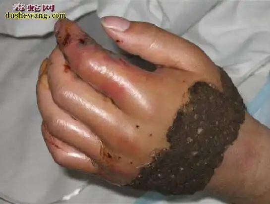 被蛇咬伤图片,被蛇咬伤各种症状图片大全_蛇的图片_毒蛇网