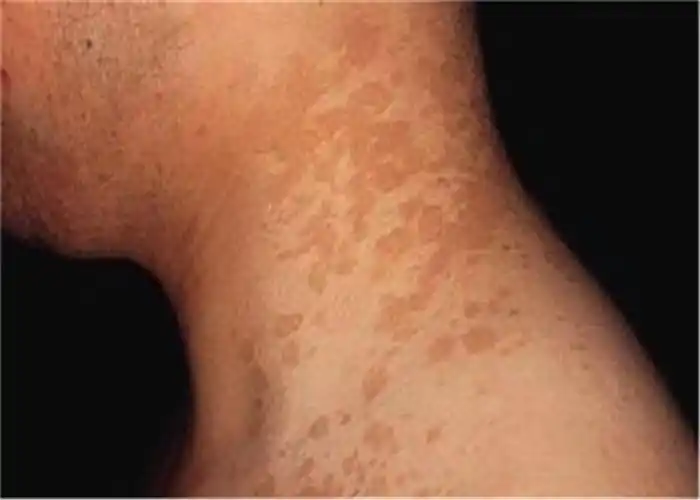 男人背部初期症状图片花斑癣孩子额头皮肤炎症图片花斑癣孩子脸部初