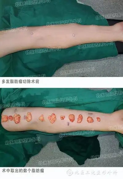 人身上能长多少个脂肪瘤