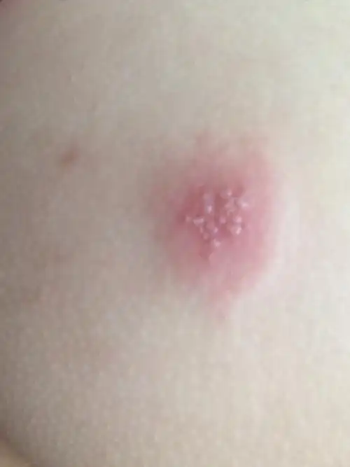 屁股上长了一个小水泡之类的这种东西有点痛也痒抹了皮炎平