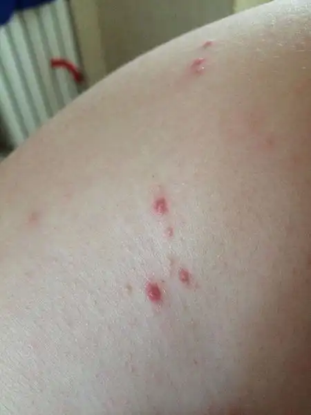 痘痘,两个周了还不消退,吃消炎药擦百多邦也不见好,会不会是梅毒疹啊