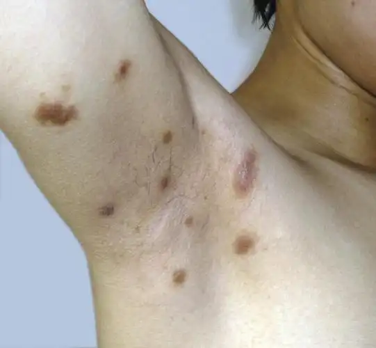 为一种病因不明的累及多系统的无干酪样坏死的上皮样细胞肉芽肿性疾病