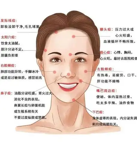 长痘痘的位置图解脸上长痘对应五脏示意图