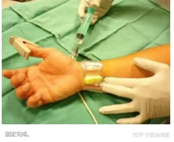 心脏支架的真实样子图解手术过程