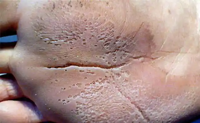 大家做好心理准备,我们来看4张较"重口"的症状图片.