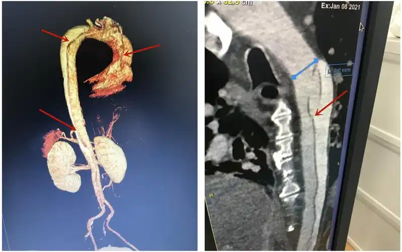 1 胸腹主动脉夹层ct 破裂的血管.jpg