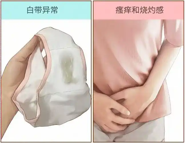 女性_霉菌性_治疗