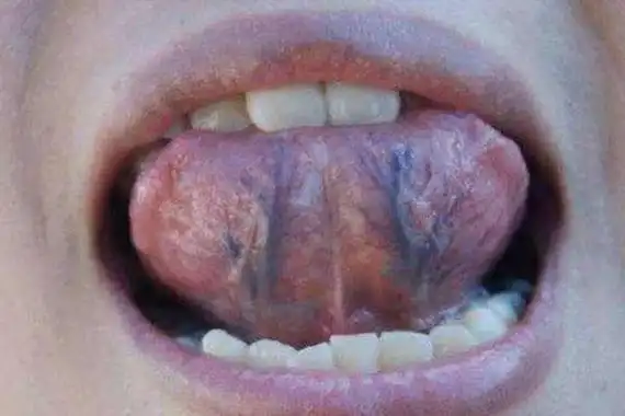 通常情况下,青筋的形态是不突出的,但是如果发现舌头下面的青筋异常