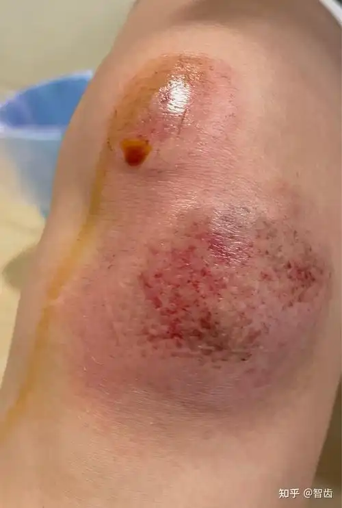 骑车摔伤记录 - 知乎