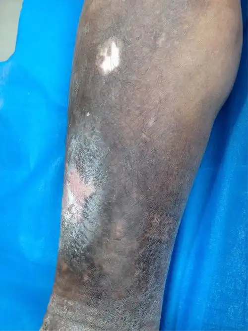 久治不愈的静脉曲张老烂腿慕名就诊,治疗效果对比!