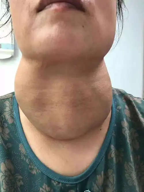 16,淋巴结肿大 淋巴结在人体中有成百上千,它的功用与"烽火台"差不多