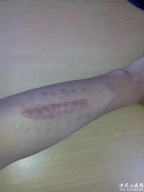 萎缩性疤痕表现特征_海南房产网_推广