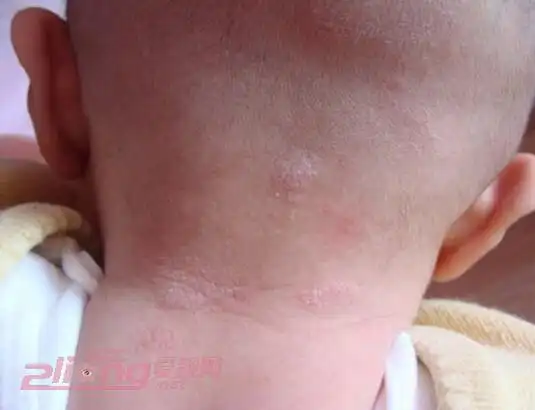 四,皮肤出现围绕毛孔的圆形点状斑疹,然后可逐渐增大至甲盖大小.