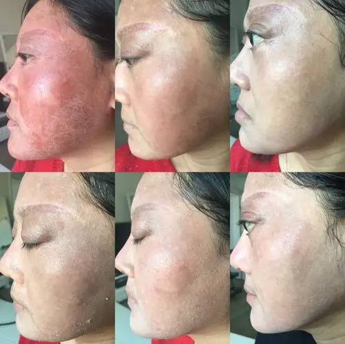 平复破裂的微血管,增进弹性,对干燥易痒的皮肤极佳.