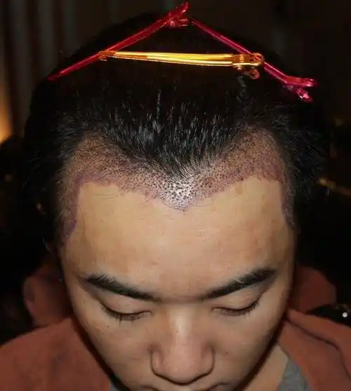 网友称华晨宇是自己老公,还晒出多张华晨宇植发照片,称张碧晨是小三