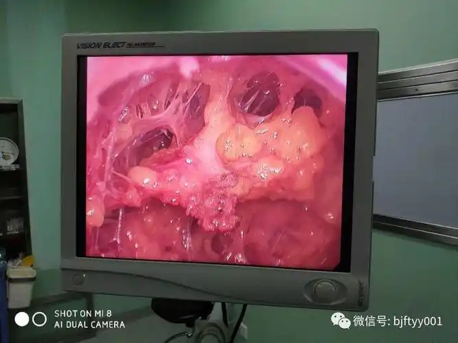 副乳--【腔镜技术在乳腺外科中的应用(2)】既完整切除肿物又达到美容