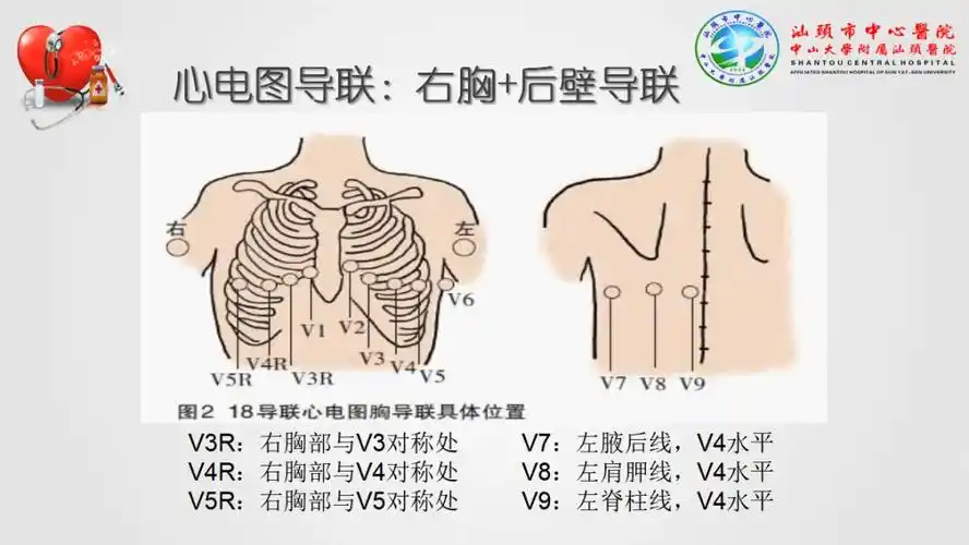 干货心肌梗死心律失常异常心电图大盘点