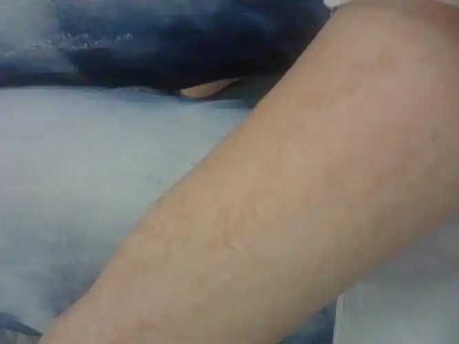 基因引起的色素沉淀有治疗的方法吗