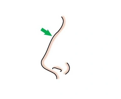 鹰钩鼻治疗方法一定要手术?