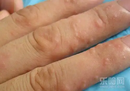 水疱型手癣导致长小水泡