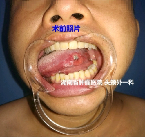 舌癌的手术治疗(附术前,术后照片)_舌癌_病因_症状_检查_手术_日常