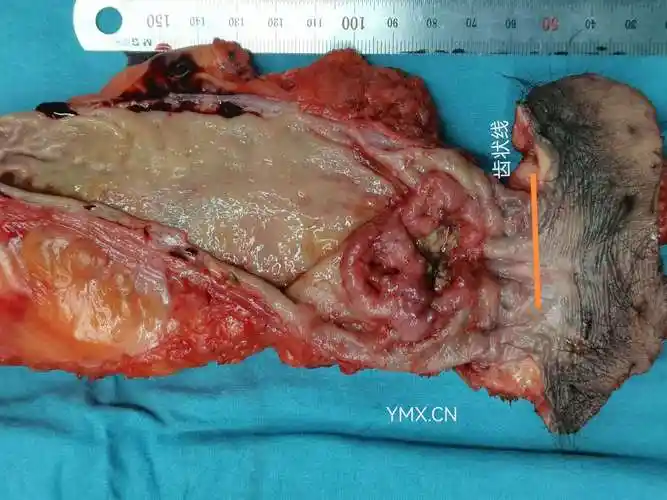超低位直肠癌实体标本和磁共振成像图一一对照复盘_直肠癌_检查_治疗